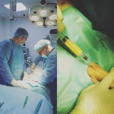 Penile thickening is possible with the help of surgery